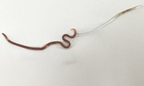 The worm was still alive when it was removed by doctors.