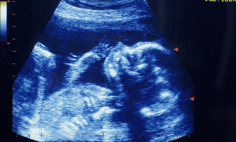 Ultrasound scan of foetus at 20 weeks.