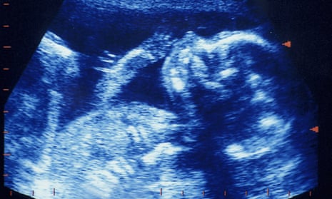 Ultrasound scan of a foetus.