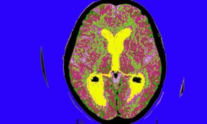 A brain scan of a patient with Alzheimer’s disease.