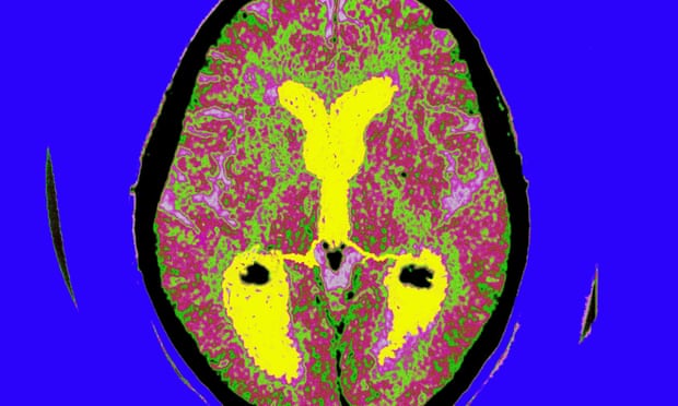 A brain scan of a patient with Alzheimer’s disease