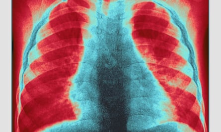 A colourised chest x-ray with large parts of the lungs in red