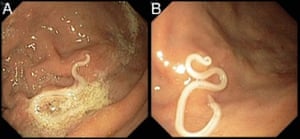 Two views of the parasite, seen here firmly attached to an area of the patient’s upper gastrointestinal tract.