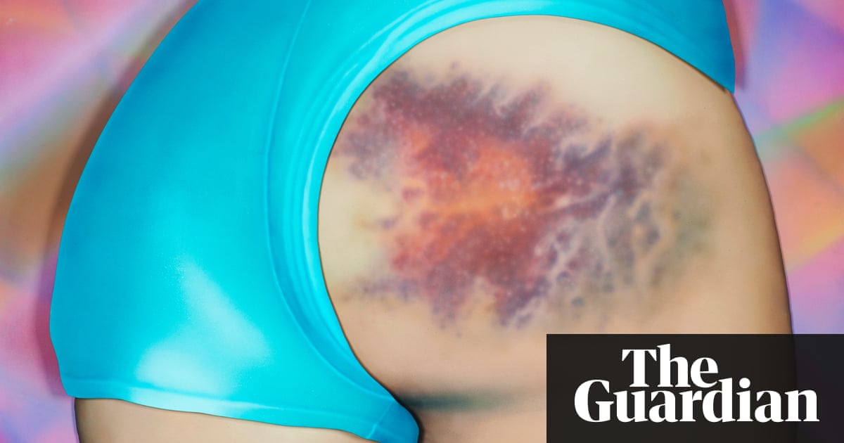 Bruised Bottoms The Multicoloured Markings Of Roller Derby In bruised-bottoms-the-multicoloured-markings-of-roller-derby-in