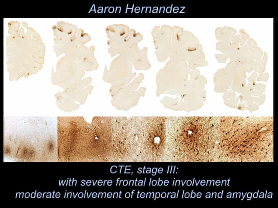 Aaron Hernandez’s brain