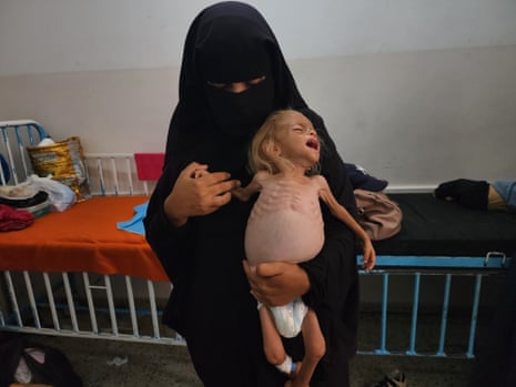Two-year-old Sham Kadih, who is suffering from malnutrition, is treated at Gaza’s Nasser hospital, on 9 August 2025.