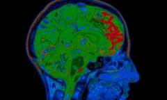 MRI image of a head with the brain highlighted in green