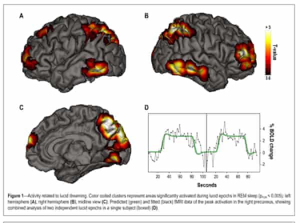 fMRI scans showing areas of the brain activated during lucid periods in REM sleep.