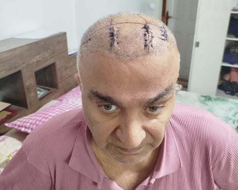 A man in a pink shirt shows his shaved head, which has three rows of large stitches and other lines of scarring