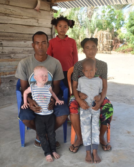 A man, woman and their three children, one of whom has albinism