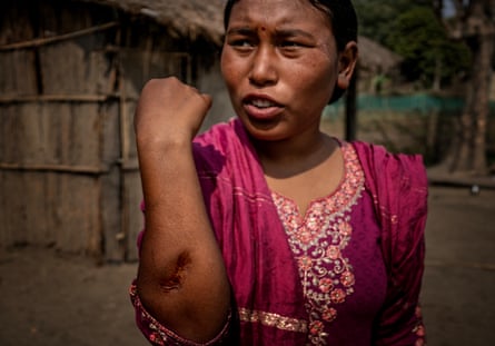 A woman shows a large wound on her forearm