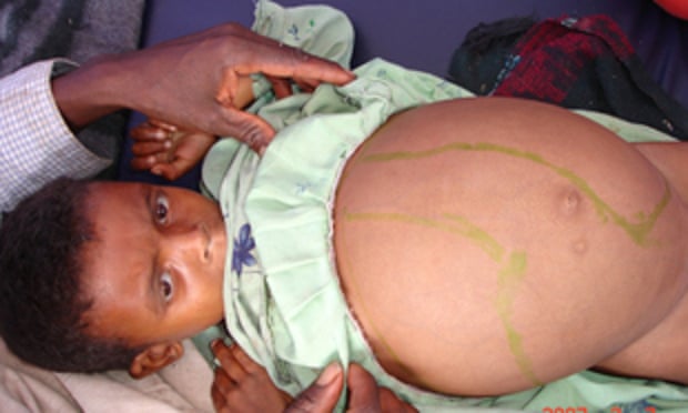 Girl suffering from visceral leishmaniasis – a potentially fatal condition, if untreated - with markers showing signs of liver and spleen enlargement. Libo Kemkem district, Ethiopia