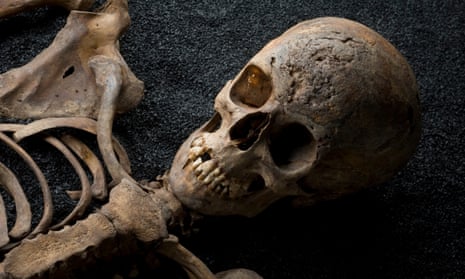This skeleton from medieval London shows evidence of syphilis, a resolutely urban disease.
