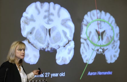 a woman stands in front of a slide showing images of the healthy brain of a normal 27-year-old compared to the squished brain of aaron hernandez