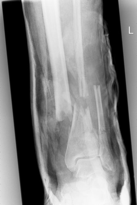 The initial x-ray of Ed Vulliamy’s leg on arrival at hospital