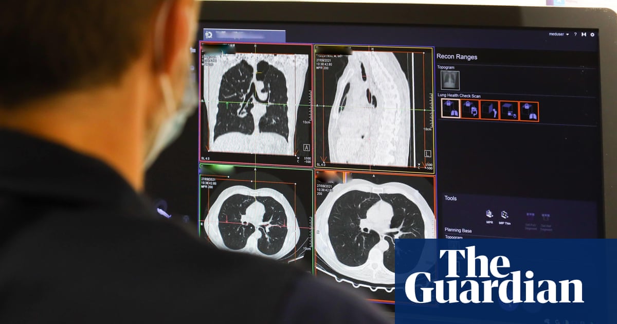 Thousands dying needlessly from cancer in UK, report says