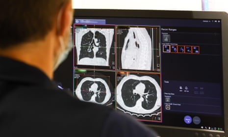 A member of staff looks at the results of a lung scan. Patients who participated in the UK trial included those with lung, breast, prostate and bowel cancers.
