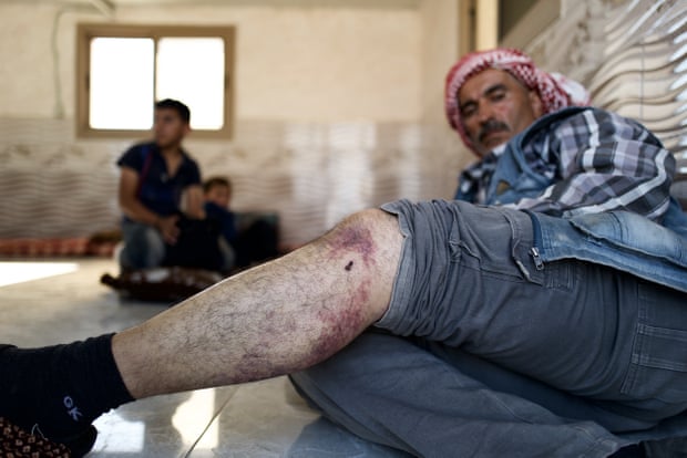 A man in a keffiyeh shows a wound on his leg