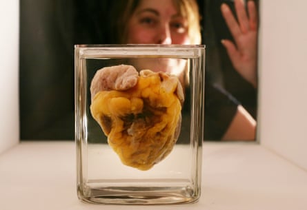 Heart transplant patient, Jennifer Sutton, looks at her heart which was removed during surgery.