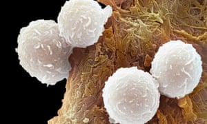 Magnified white blood cells from a patient with leukaemia.