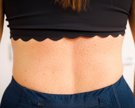 A closeup of small indents on the reporter’s back