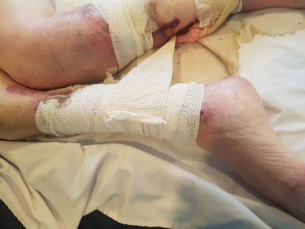 A photo was taken of Milka’s wounded leg with ants crawling from the wound.