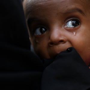 Uma criança desnutrida Rohingya