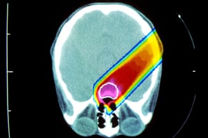 A proton beam irradiating a brain tumour (circled in white) … many anti-cancer therapies destroy fertility either chemically or through radiation.