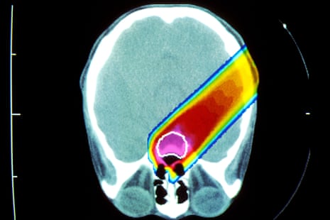 A proton beam irradiating a brain tumour (circled in white) … many anti-cancer therapies destroy fertility either chemically or through radiation.