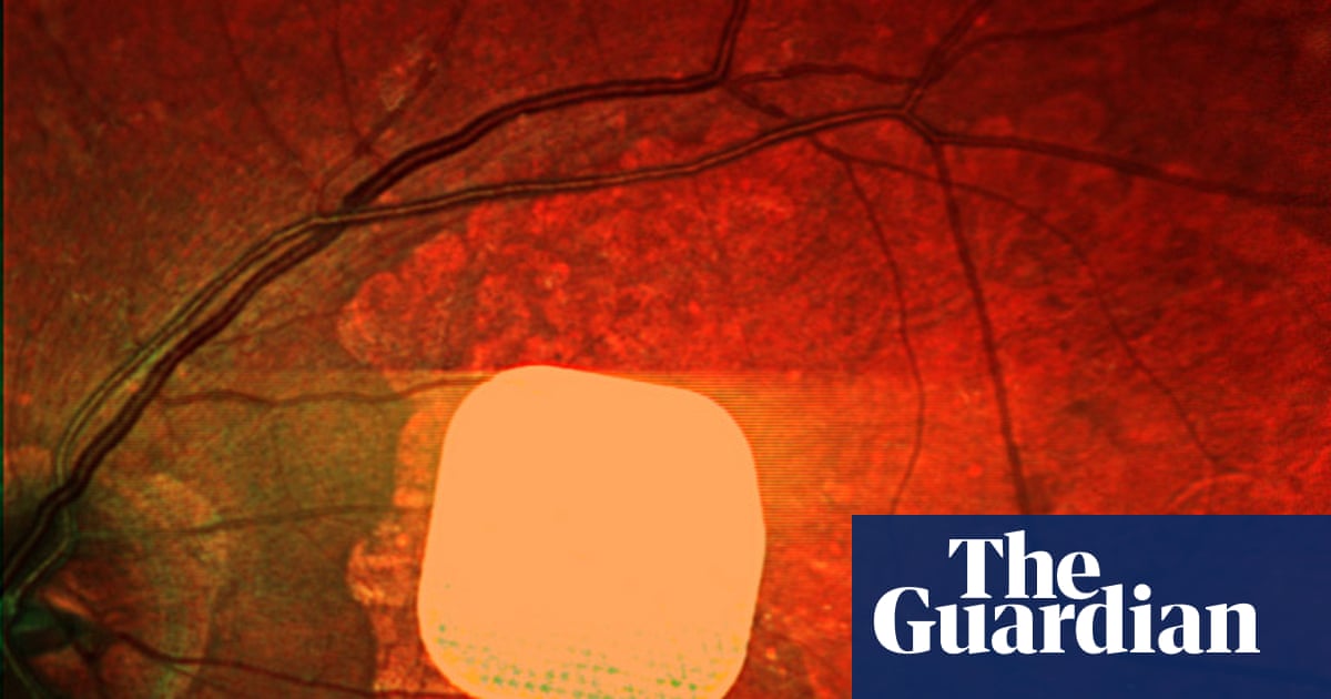 PRIMA Implant Restores Reading Vision in 84%