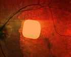 Experts hail ‘remarkable’ success of electronic implant in restoring sight