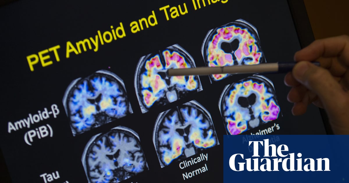 Australia approves new drug to treat early Alzheimer’s disease | Alzheimer’s Australia approves new drug to treat early Alzheimer’s disease | Alzheimer’s