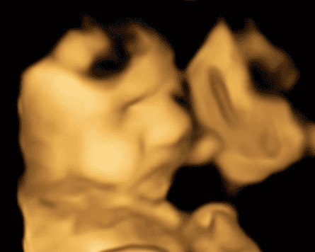 Ultrasound image of foetus