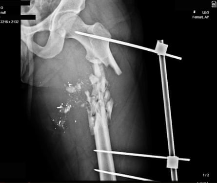 X-ray showing a shattered femur.