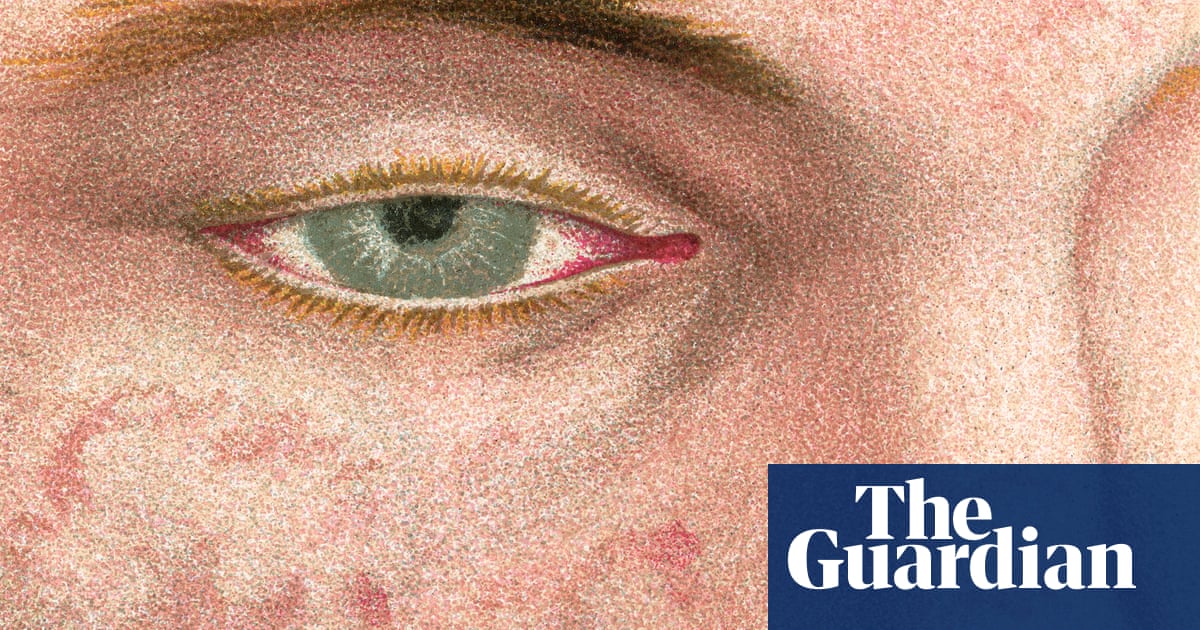 A Near Miss: The Alarming Resurgence of Measles in the UK A Near Miss: The Alarming Resurgence of Measles in the UK