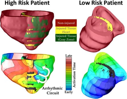 This shows risk prediction for two patients with previous cardiac injury, one classified as high risk, and the other as low risk. In the high risk heart, arrhythmia developed, indicated by the electrical wave that was “stuck” rotating around the injury. In the low risk heart, despite the presence of injury, no arrhythmia occurred.