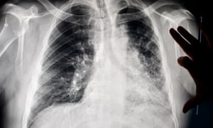 A chest x-ray in the office of Dr Brandon Crum in Pikeville, Kentucky.