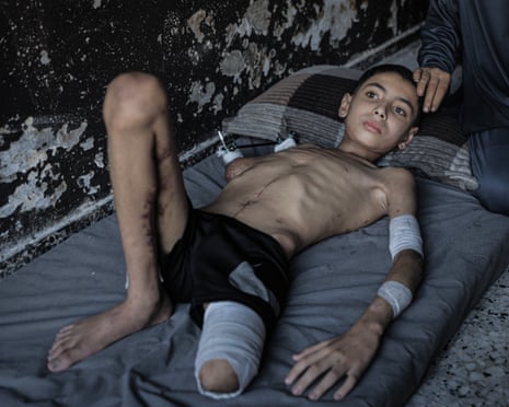 Samir Muhammed Samir Zekut, 11, fights for life at his home on August 07, 2025, due to insufficient treatment after being seriously injured in an Israeli attack on a house in Sheikh Radwan neighborhood, northern Gaza on May 27, 2025. He lost his left leg and right arm in the attack and has multiple shrapnel wounds. His family calls for urgent medical evacuation outside Gaza as he suffers from stomach and colon perforations, deep wounds on his back and foot, and severe nerve damage in his right arm. (Photo by Ahmed Jihad Ibrahim Al-arini/Anadolu via Getty Images)