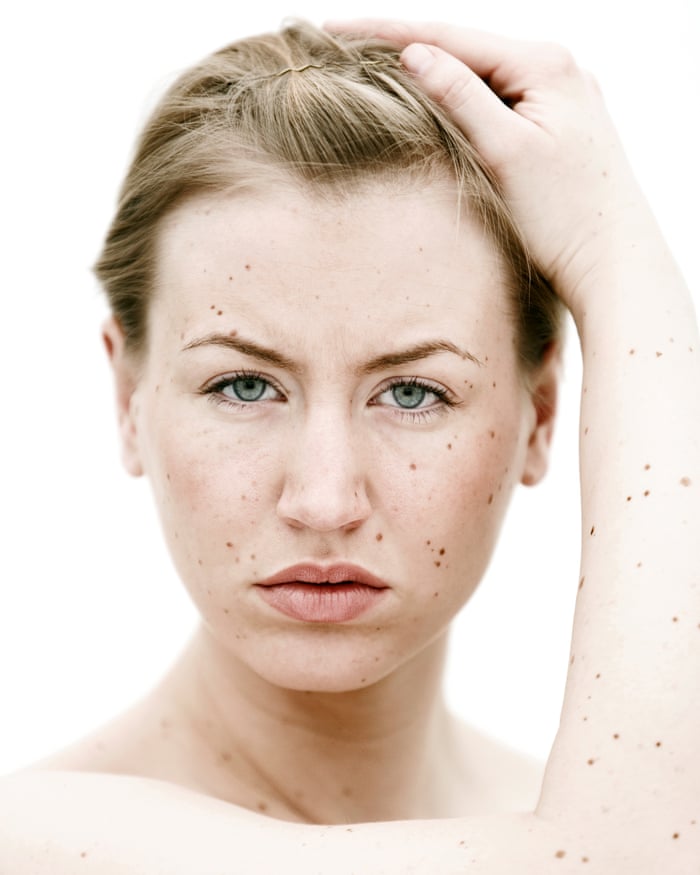 Everything You Ever Wanted To Know About Moles But Were Too Busy On The Sunbed To Ask Health Wellbeing The Guardian