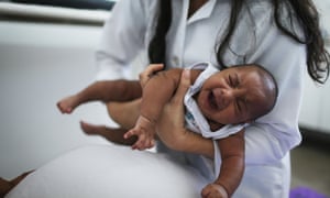 A baby in Brazil born with microcephaly