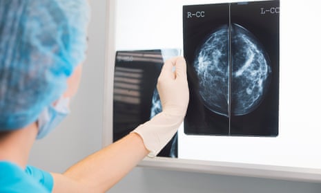 Breast cancer screening – is it worth it?, Health & wellbeing