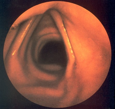 A closeup of a healthy larynx.