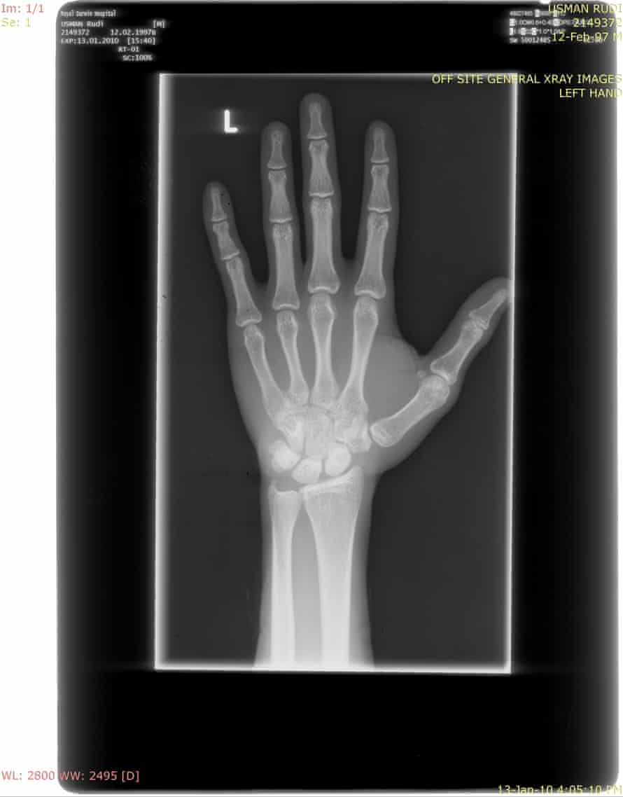 The X-ray image of Rudi Usman’s wrist