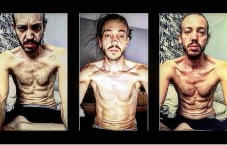 ‘كنت أتبول دمًا باستمرار’: جحيم الكيتامين الخاص بي – وما جعلني أتوقف ‘كنت أتبول دمًا باستمرار’: جحيم الكيتامين الخاص بي – وما جعلني أتوقف