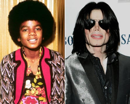 Michael Jackson after his cosmetic procedures.