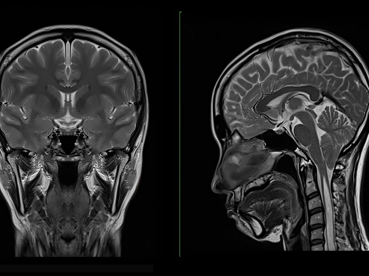 Parkinson's disease detectable before physical symptoms show ...