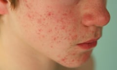 Pre-teen boy suffering from Acne<br>ADOLESCENT ACNE
13 ANS
BASTIEN LAVALOU
