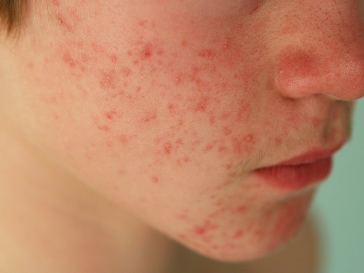 Roaccutane cost nhs