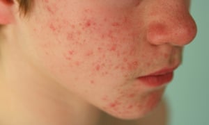 Teenage Acne Treatments That Work Uk 25 3630