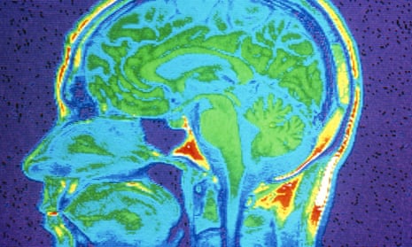 MRI scan of brain, close-up.